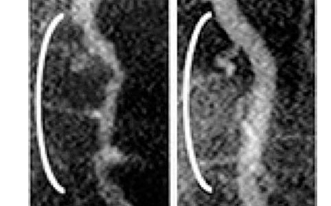 What Bill Clinton's cardiologist didn't know (and why you need to know it)