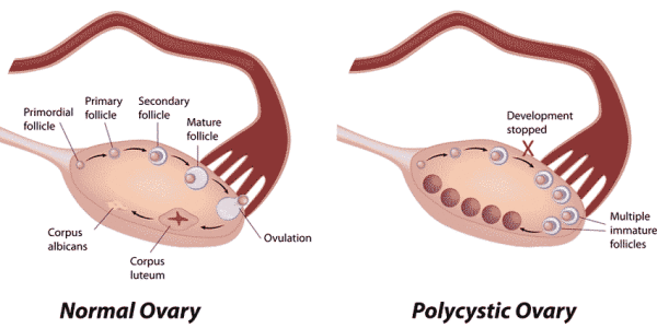 Plant-based diets for the treatment of Polycystic Ovary 